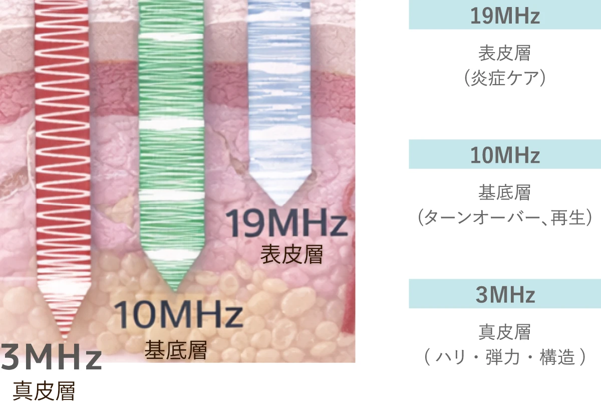 高密度超音波による肌構造アプローチ